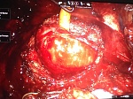 Case Report радикальной простатэктомии с роботической ассистенцией при раке предстательной железы со средней долей гиперплазии предстательной железы