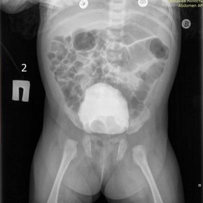 Особенности CAKUT-синдрома: клинический случай. Особенности CAKUT-синдрома: клинический случай.